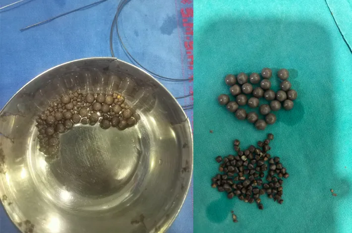 స్వప్న హాస్పిటల్ లో అరుదైన వైద్యం