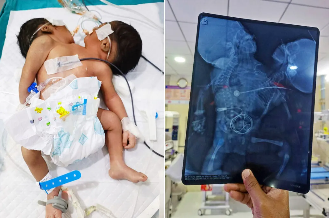 ఒకే శరీరం.. రెండు తలలు!