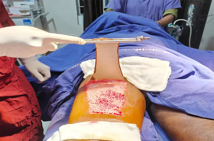 అధునాతన వైద్య సేవల్లో పెద్దపల్లి జిల్లా ఆసుపత్రి మరో మైలురాయి
